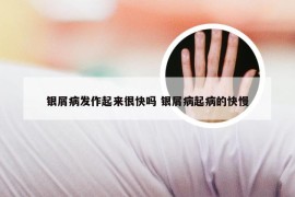 银屑病发作起来很快吗 银屑病起病的快慢