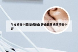 牛皮癣哪个医院好济南 济南银屑病医院哪个好