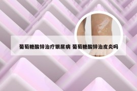 葡萄糖酸锌治疗银屑病 葡萄糖酸锌治皮炎吗