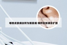 哪类皮肤病会转为银屑病 哪种皮肤病会扩散