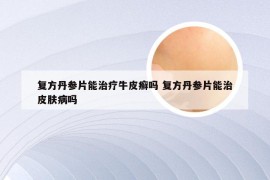 复方丹参片能治疗牛皮癣吗 复方丹参片能治皮肤病吗