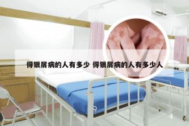 得银屑病的人有多少 得银屑病的人有多少人
