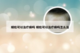 蜈蚣可以治疗癣吗 蜈蚣可以治疗癣吗怎么治