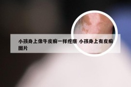 小孩身上像牛皮癣一样疙瘩 小孩身上有皮癣图片