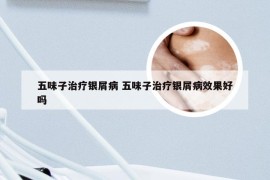 五味子治疗银屑病 五味子治疗银屑病效果好吗