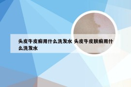 头皮牛皮癣用什么洗发水 头皮牛皮肤癣用什么洗发水
