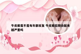 牛皮廨是不是每年都反复 牛皮廨后期会越来越严重吗