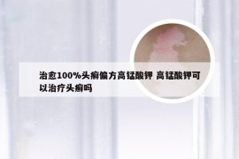 治愈100%头癣偏方高锰酸钾 高锰酸钾可以治疗头癣吗
