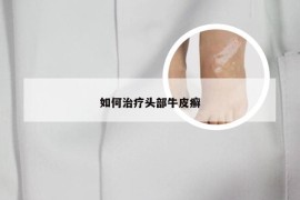 如何治疗头部牛皮癣