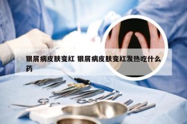 银屑病皮肤变红 银屑病皮肤变红发热吃什么药