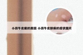 小孩牛皮廨的原因 小孩牛皮肤癣的症状图片