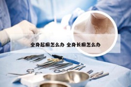 全身起癣怎么办 全身长癣怎么办