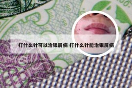 打什么针可以治银屑病 打什么针能治银屑病