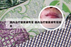 国内治疗银屑病专家 国内治疗银屑病专家排名