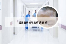 后背肩膀长牛皮癣 肩膀 癣