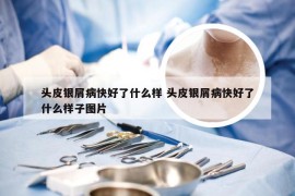 头皮银屑病快好了什么样 头皮银屑病快好了什么样子图片