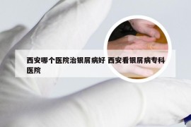 西安哪个医院治银屑病好 西安看银屑病专科医院