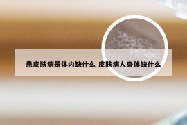 患皮肤病是体内缺什么 皮肤病人身体缺什么