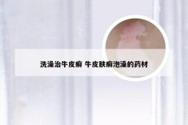 洗澡治牛皮癣 牛皮肤癣泡澡的药材
