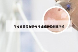 牛皮廨是否有遗传 牛皮廨传染到孩子吗