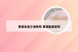 晕痣会自己消失吗 晕痣能痊愈吗