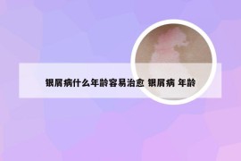 银屑病什么年龄容易治愈 银屑病 年龄