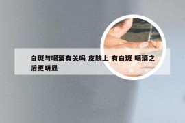 白斑与喝酒有关吗 皮肤上 有白斑 喝酒之后更明显