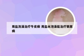 用盐洗澡治疗牛皮癣 用盐水泡澡能治疗银屑病