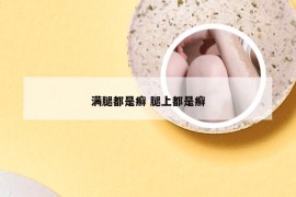 满腿都是癣 腿上都是癣
