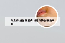 牛皮癣t细胞 银屑病t细胞和其他t细胞不同