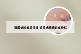 银屑病脱痂后很痒 银屑病结痂蜕皮粉红