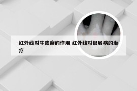 红外线对牛皮癣的作用 红外线对银屑病的治疗