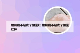 银屑病不起皮了但是红 银屑病不起皮了但是红肿