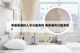 有银屑病的人可以植发吗 银屑病可以植发吗?