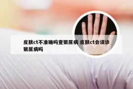 皮肤ct不准确吗查银屑病 皮肤ct会误诊银屑病吗