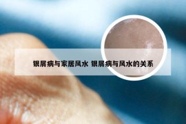 银屑病与家居风水 银屑病与风水的关系
