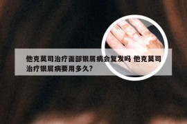 他克莫司治疗面部银屑病会复发吗 他克莫司治疗银屑病要用多久?