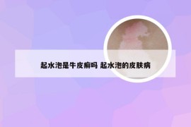 起水泡是牛皮癣吗 起水泡的皮肤病