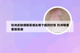 杭州皮肤病银屑病去哪个医院好些 杭州哪里看银屑病