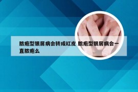 脓疱型银屑病会转成红皮 脓疱型银屑病会一直脓疱么