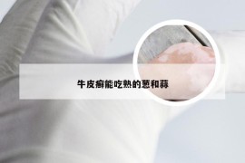 牛皮癣能吃熟的葱和蒜