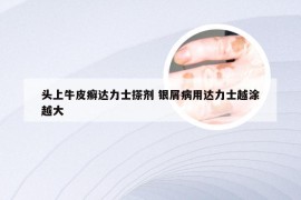 头上牛皮癣达力士搽剂 银屑病用达力士越涂越大