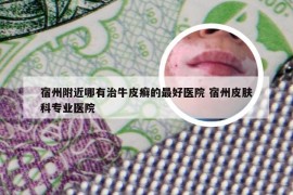 宿州附近哪有治牛皮癣的最好医院 宿州皮肤科专业医院