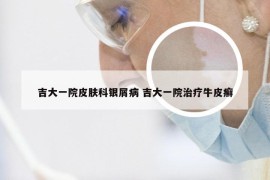 吉大一院皮肤科银屑病 吉大一院治疗牛皮癣