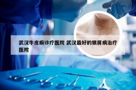 武汉牛皮癣诊疗医院 武汉最好的银屑病治疗医院