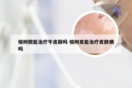 榆树胶能治疗牛皮藓吗 榆树皮能治疗皮肤病吗