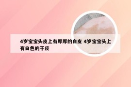 4岁宝宝头皮上有厚厚的白皮 4岁宝宝头上有白色的干皮