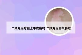 二妙丸治疗腿上牛皮癣吗 二妙丸治脚气特效