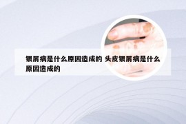 银屑病是什么原因造成的 头皮银屑病是什么原因造成的