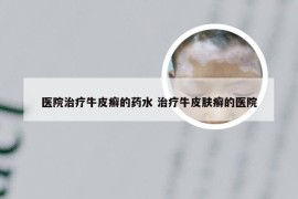 医院治疗牛皮癣的药水 治疗牛皮肤癣的医院